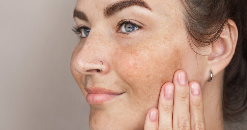 taches brunes visage