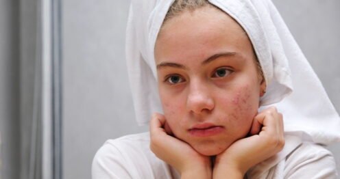 routine peau grasse acné