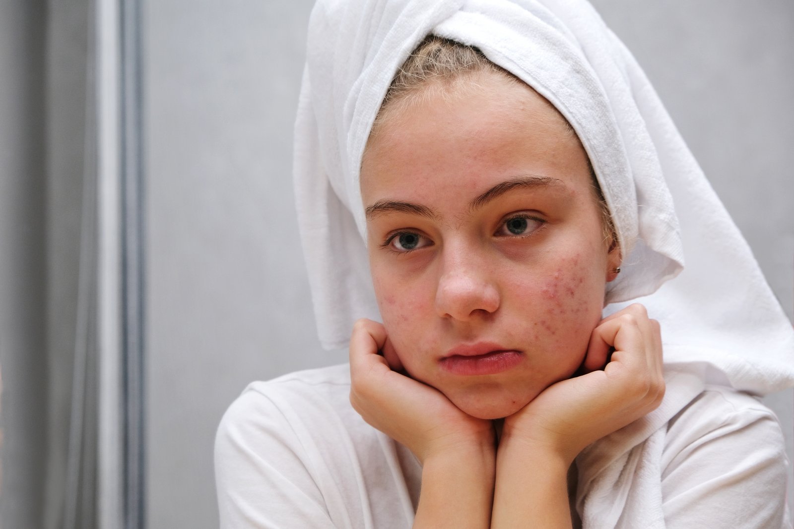 routine peau grasse acné