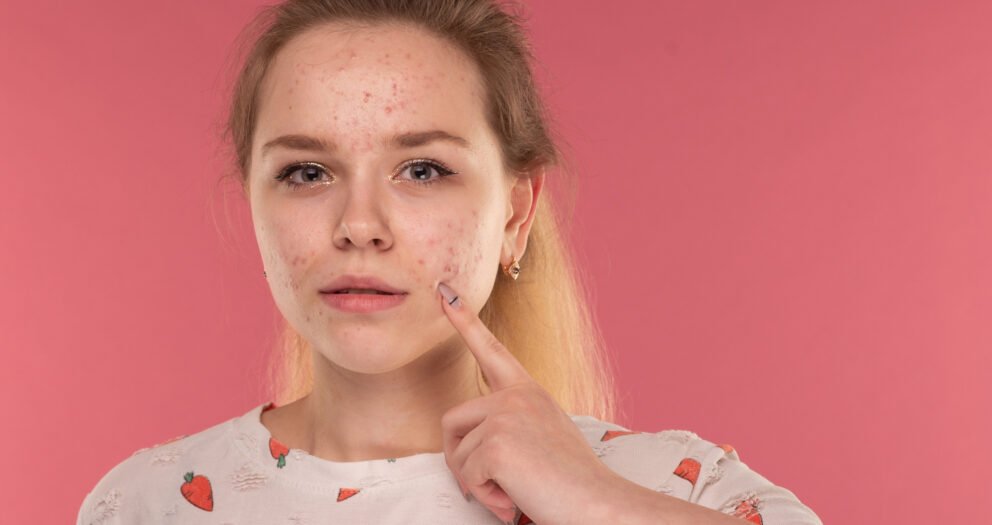 boutons menton adulte causes