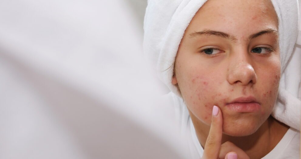 acide salicylique acné comment utiliser