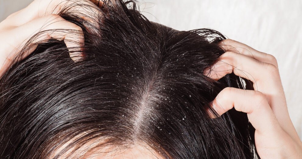 Routine cuir chevelu gras