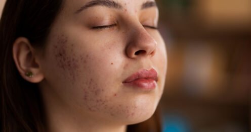 Acné adulte et stress : quel lien ?