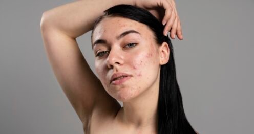 Marques post-acné rouge ou brune : différence