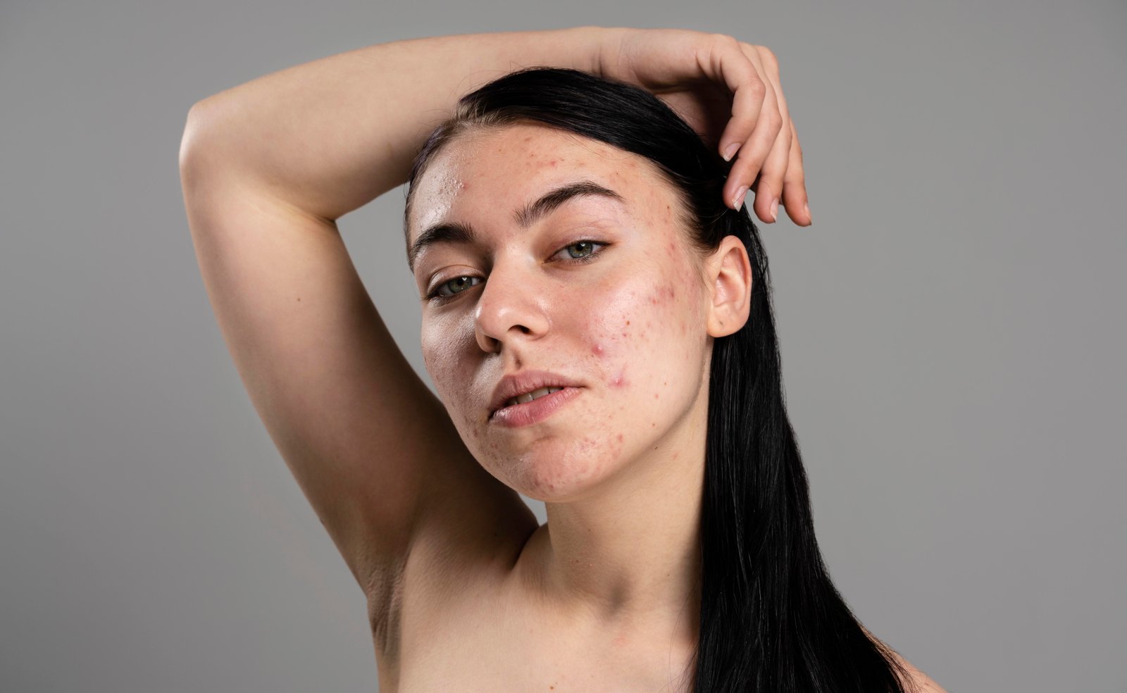 Marques post-acné rouge ou brune : différence