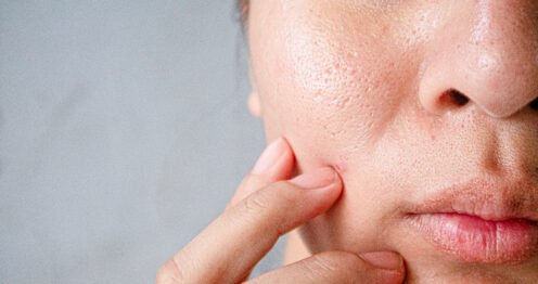 peau grasse du visage