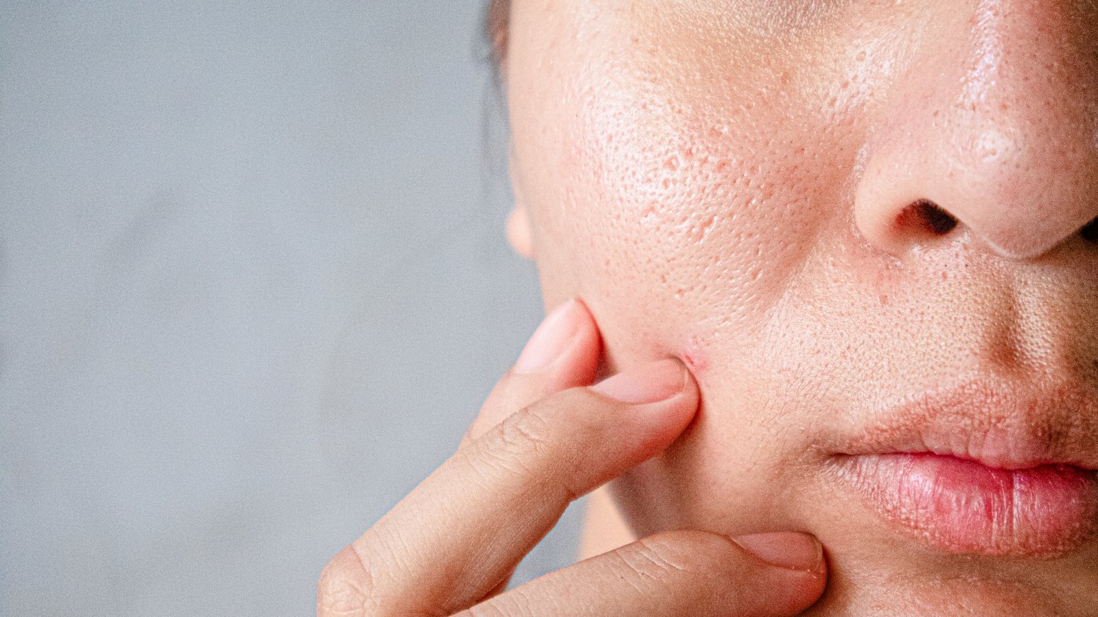 peau grasse du visage