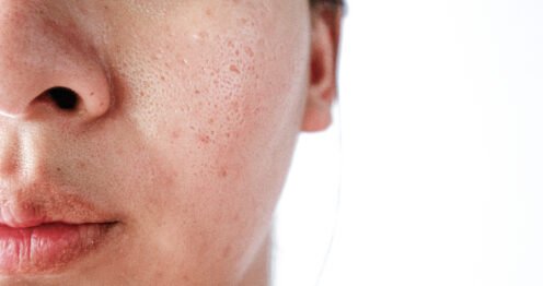 resserrer les pores naturellement