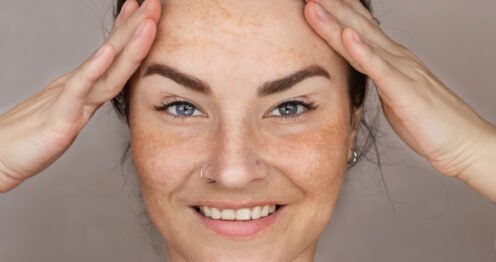 البقع الداكنة في الوجه