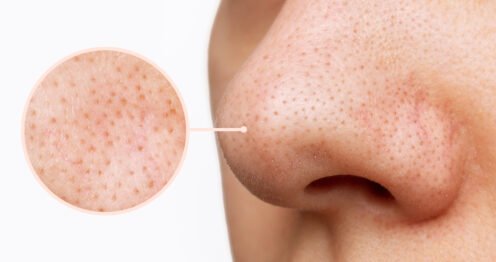 pores dilatés du visage