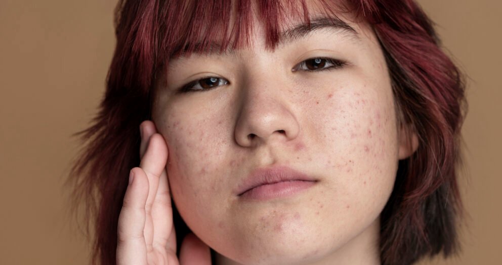 روتين حب الشباب