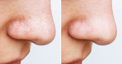 points noirs sur le nez