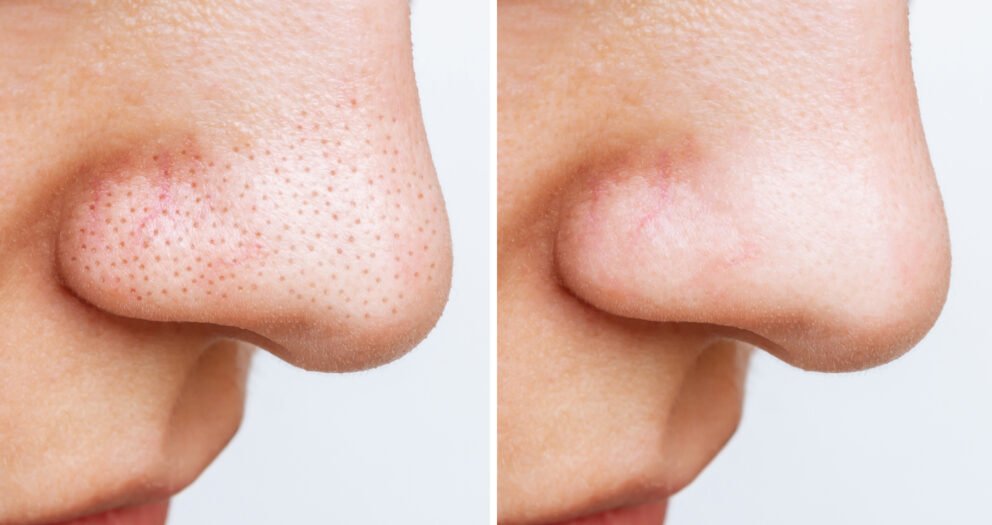 points noirs sur le nez