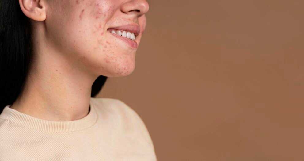 تصبغات الوجه